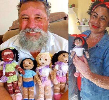 This Grandfather Creates Dolls With Vitiligo To Help Children Feel Better About Their Skin Condition