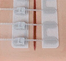 ZipStitch: Laceration Kit Lets You Close Wounds Without Stitches