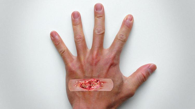 Boo-Boos Band-Aids Pictures of Severe Injuries