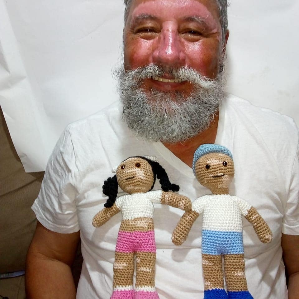 vitiligo crochet dolls - Grandfather with vitiligo skin condition creates crochet dolls