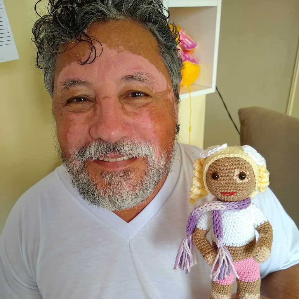 vitiligo crochet dolls - Grandfather with vitiligo skin condition creates crochet dolls