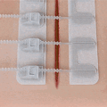 ZipStitch: Laceration Kit Lets You Close Wounds Without Stitches