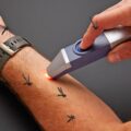 This Genius Gadget Instantly Relieves Itch and Pain Related To Bug Bites and Stings